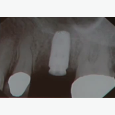 Biocompatible Bone Regenerative Materials