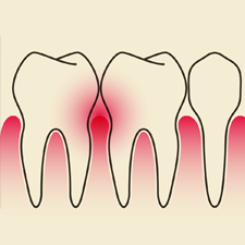Dental Research from the Body Farm – Dental Bone Disease